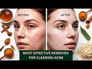 Get Rid of Acne with These 3 DIY Skin Masks!