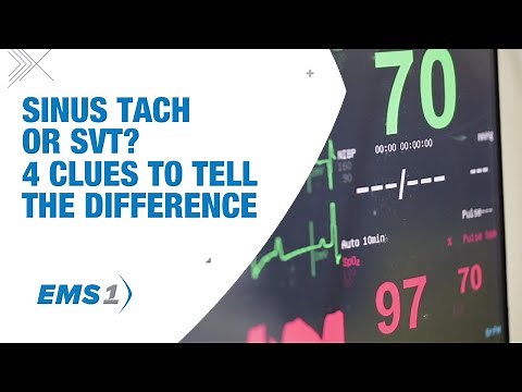 Sinus tach or SVT? 4 clues to tell the difference