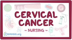 Cervical cancer: Nursing: Video & Causes | Osmosis