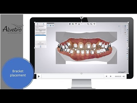 Bracket Placement Set Up and Design for Indirect bonding with 3Shape Indirect Bonding Studio