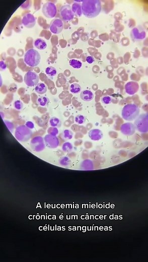 Entendendo a Leucemia Mieloide Crônica no Microscópio