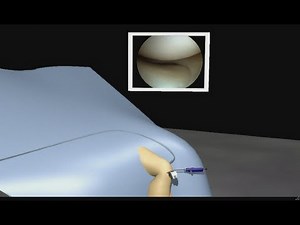 Knee Arthroscopy