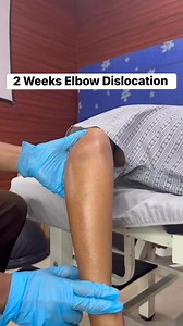 35K views · 498 reactions | 2 Weeks Elbow Dislocation ☺️. Clinic Location: Sevilla sta Cruz Ilocos Sur Clinic page: St. Croix Pain Management and Myotechnology Clinic | Jms Go | Facebook
