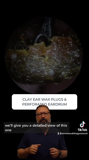Clay Ear Wax Removal and Perforated Eardrum Care