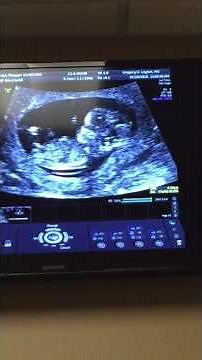 Ultrasound at 11 Weeks 5 Days