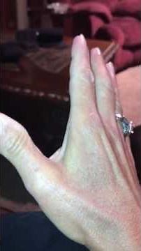 Thumb Fusion MCP joint