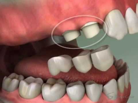 Cantilever Tooth Bridge - Roseville Dentist