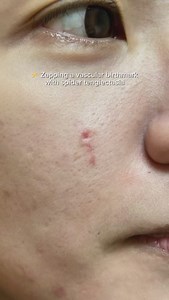 4.6K views · 30 reactions | Getting rid of a vascular birthmark one lase a time ⚡️ | Dr. Kash Dermatology | Facebook