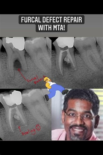 The Short Case Of The Day! Furcation Defect Perio Or Endo? #furcation #defect #MTA dentistry
