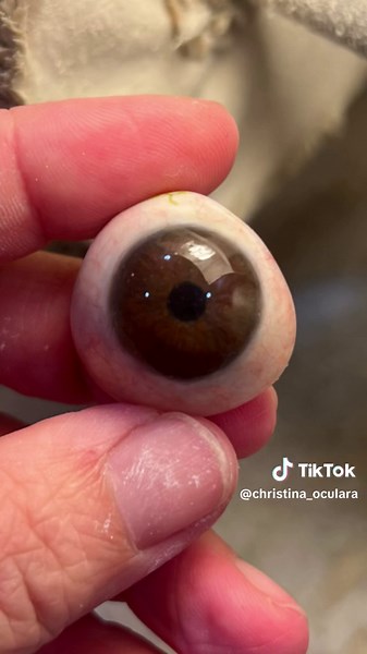 Understanding Glaucoma and Large Iris Measurements