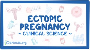 Ectopic pregnancy: Video & Meaning | Osmosis