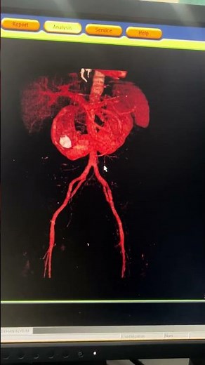 Horseshoe Shape Kidney: What You Need to Know for Your Health