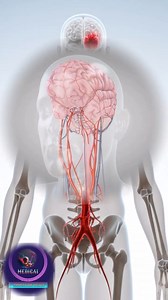 22K views · 320 reactions | When the "pipes" burst: Understanding Hemorrhagic Stroke 易. #foryou #3dmedical #StrokeAwareness #BrainHealth #HemorrhagicStroke #MedicalEmergency #HealthTips | Medical Animation Media | Facebook
