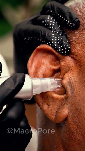 EAR BLACKHEAD REMOVAL ASMR 😌