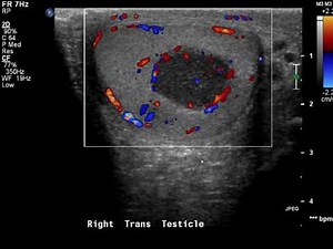 Ultrasound clues that indicate testicular lymphoma