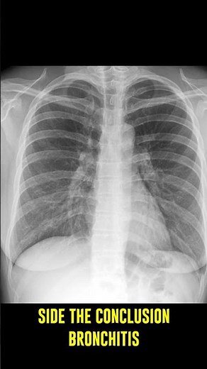 Radiology Short Spotting Bronchitis on Chest X-ray