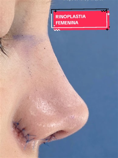 RINOPLASTIA un cambio que siempre has querido Si estas por fuera de Colombia puedes realizar una valoración virtual, agendar tu Cirugía de Nariz y estar con nosotros durante 15 días, regresando a casa para continuar con controles virtuales Recuerda que todos estos cambios los podemos obtener gracias a nuestra consulta de rinoplastia donde realizamos: ✅Análisis facial detallado ✅Evaluación endoscópica intranasal ✅Examen físico nasal ✅Simulación nasal Agenda tu cita ya ☎️ 302 418 2121 - 302 462 00