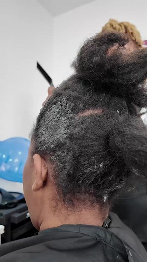 Cuir chevelu brûlé par vinaigre blanc : Arrêtez les remèdes dangereux !