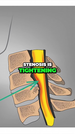 When the spinal cord becomes severely compressed and all non operative measures fail, then surgery is explored. In this case, this patient presented to my office with severe neck and arm pain. We successfully performed an ACDF and the patient is doing great!