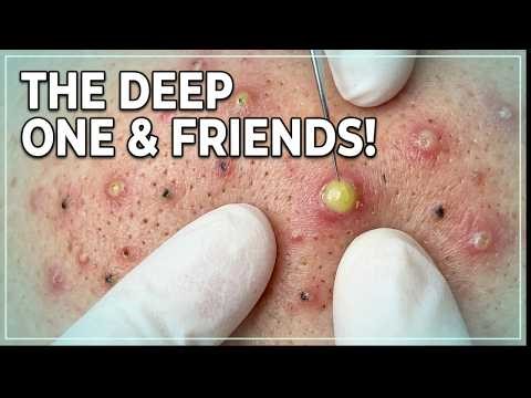 Best Blackhead Removal 2026 – My No.1 Picks & Most Satisfying Extractions Compilation