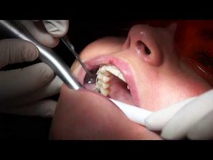 Simply Teeth - Fitting a Fastbraces® system