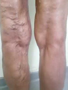 Varicose Veins