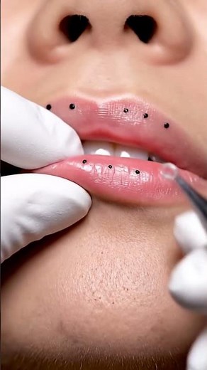 Can You Handle This Satisfying Pimple Pop?