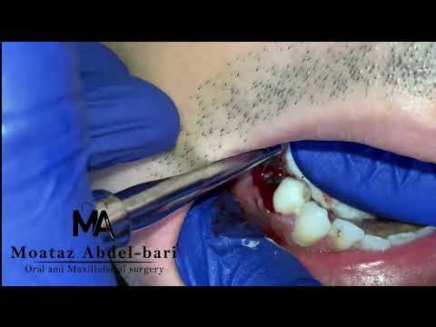 Remaining root extraction by double curved elevator