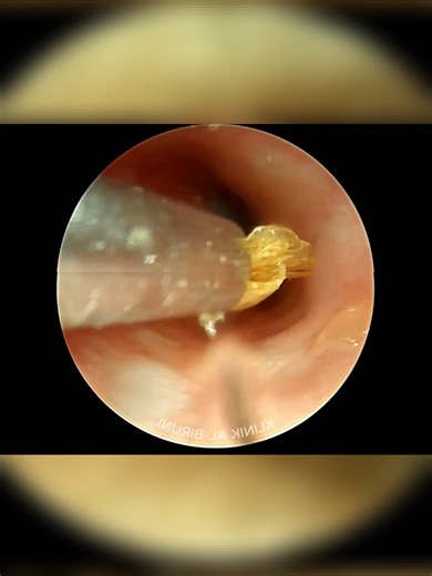 part-16 Ear cleaning asmr #cleaninghacks #cleaningasmr #cleaning #earwaxcleaning