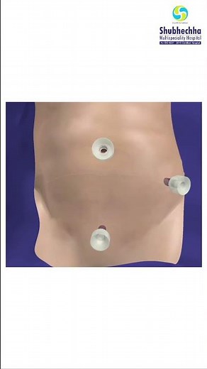 APPENDIX REMOVAL THROUGH LAPAROSCOPY | BEST SURGEON AT SHUBHECHHA HOSPITAL