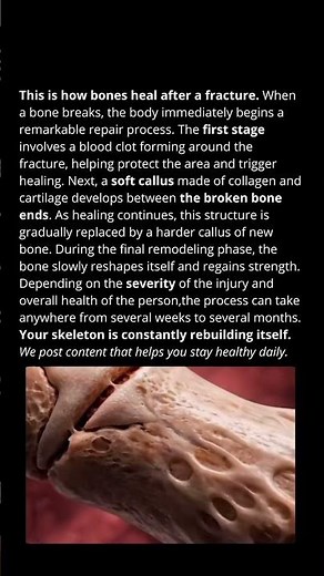This is how bones heal after a fracture.
