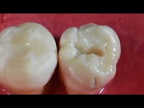 COMO se hace una RESINA DENTAL paso a paso