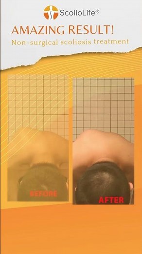 20-year-old NS boy: curve reduced, posture improved—without surgery.