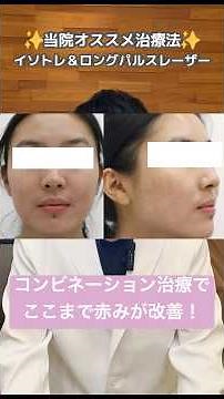 【皮膚科医解説】ニキビ跡の赤み(PIE)はこう治す！本当に効く治療法とは？