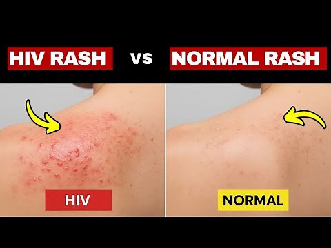 HIV Rash vs. Normal Rash – How to Find The Difference?