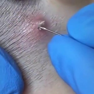 Skin Care Doctors on Instagram: "Follow us for more pimple popping videos Learn more about this at the LINK IN BIO! Repost: @pimplespopping_ #pores #skin #healthyskin #cleanpores #oilyskin #skincare #skincarenews #pimple #blackheads #cyst #face Follow @skincare_news @beauty_medical_devices @skincare_doctors ➡️ for more skincare and beauty hacks, tips, and more! #exploreskin"