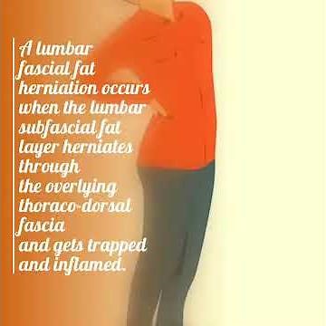 A lumbar fascial fat herniation occurs when the lumbar subfascial fat layer herniates through the o…