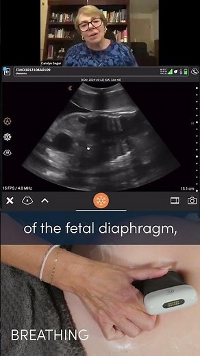 Biophysical Profile in Action: A Look at Fetal Breathing