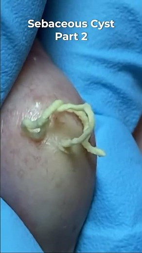 Sebaceous Cyst Part 2