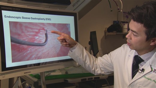 Endoscopic sleeve gastroplasty: A new approach to weight loss