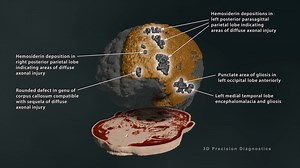 Large Hemosiderin Deposition, Gliosis & Encephalomalacia: Brain MRI Findings - 3DPD