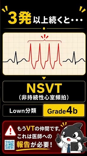 問題です。PVCは何発続くと危険でしょう？lown分類って覚えてる？ #医学生 #夜勤 #雑学 #心電図 #心電図検定 #看護師 #訪問看護師 #モニター #看護学生