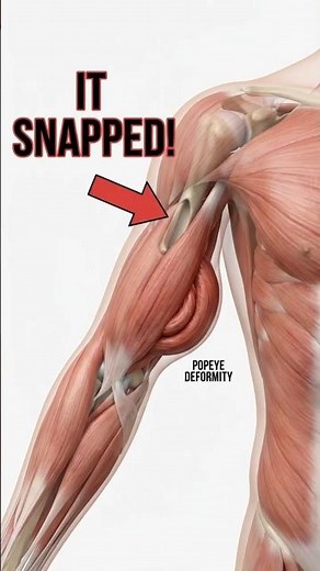 The Bicep can RIP itself? 💪 (The Popeye Deformity)