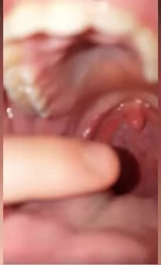 Massive tonsil stone pop #tonsils #tonsil #pop #extraction #fyp #fypシ