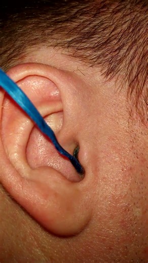 ENT Doctor removes a💎Diamond from an👂Ear [ASMR] #entdoctor #diamond #removes #asmr #asmrvideo #ear