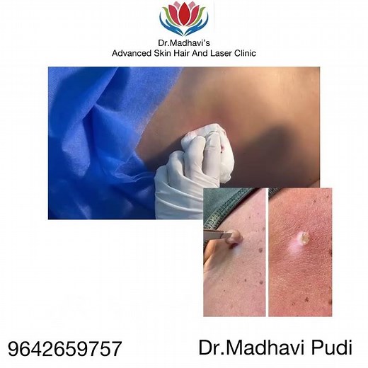 Gaint Acrochordons Removal.... #drmadhavipudi #acrochordonsremoval #safeprocedure #goodresults #hyd