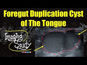 Foregut Duplication Cyst of The Tongue || Ultrasound || Case 357