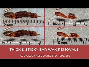 THICK & STICKY EAR WAX REMOVAL - EP 205
