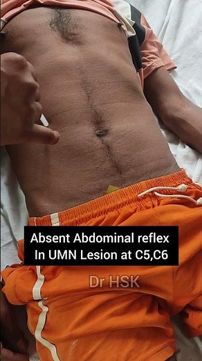 Abdominal reflex examination #neurology #cervical #cervicaltreatment #spinalcordinjury #spineinjury