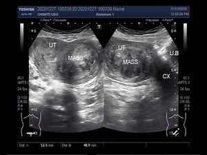 A Large Fibroid with a large Ovarian Cyst.